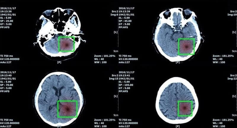 Visión por computadora en análisis de imágenes médicas